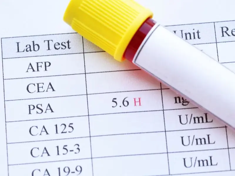 quando o PSA é preocupante para os homens